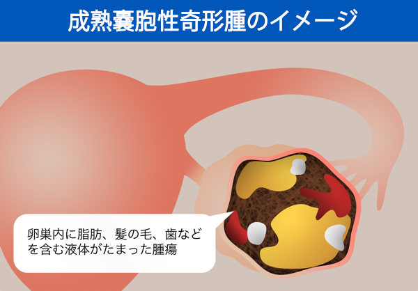 奇形腫とは何ですか?